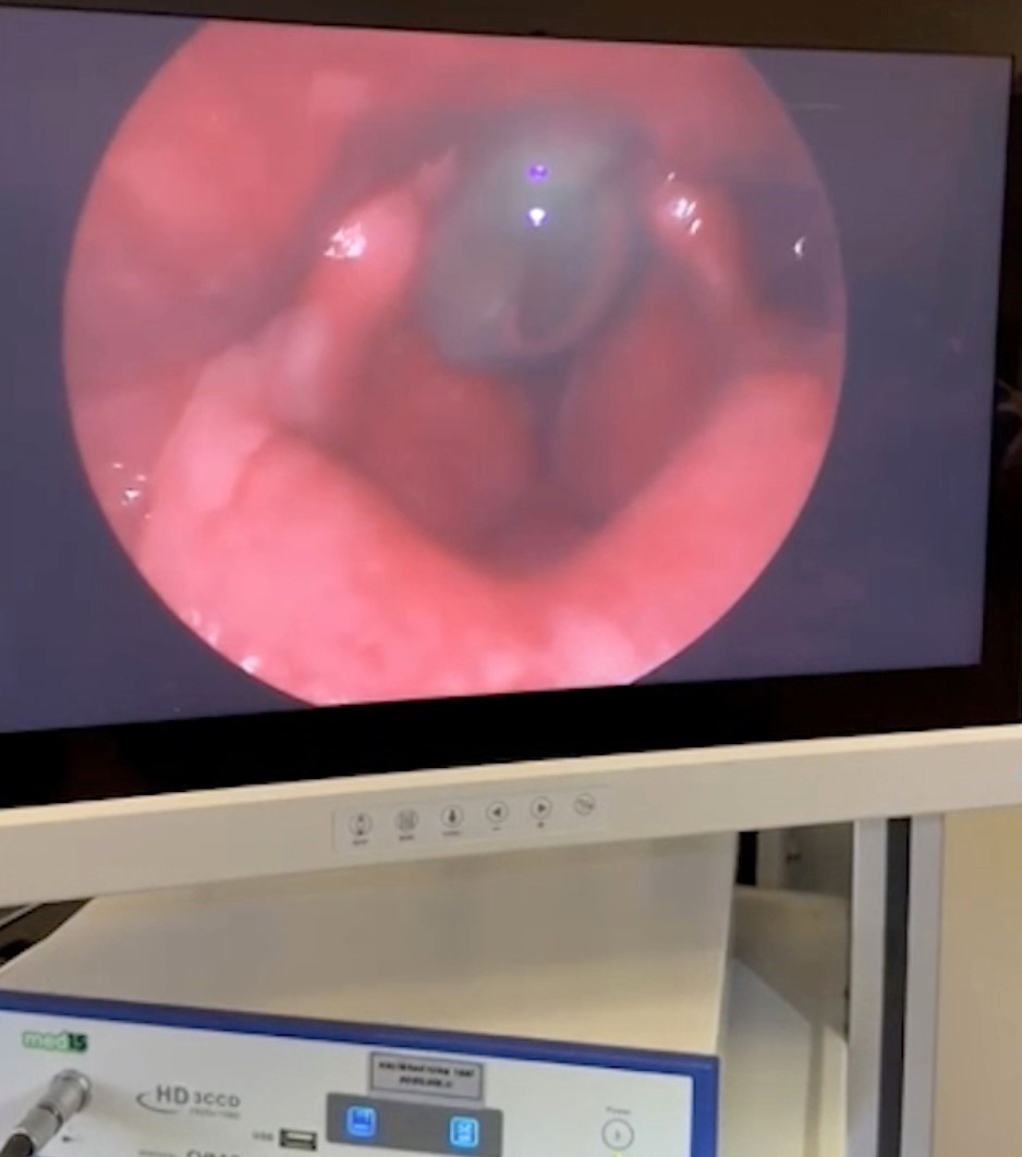 Vatandaşın boğazından &ccedil;ıkan canlı s&uuml;l&uuml;k doktorları bile şaşırttı: "İlk defa g&ouml;rd&uuml;m"