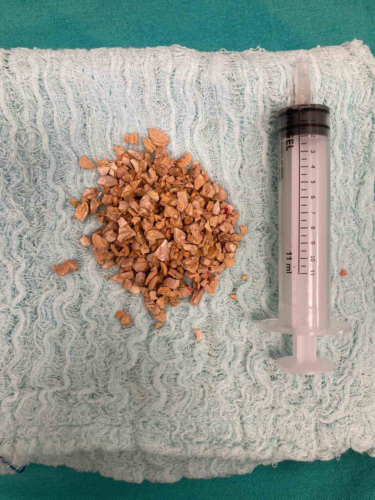 Bayburt’ta 84 yaşındaki hastanın mesane taşları kapalı yöntemle çıkarıldı