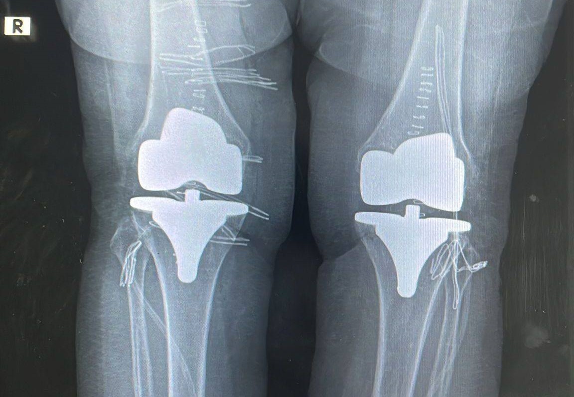 &Ccedil;ift taraflı diz proteziyle 73 yaşındaki hastanın ağrıları giderildi
