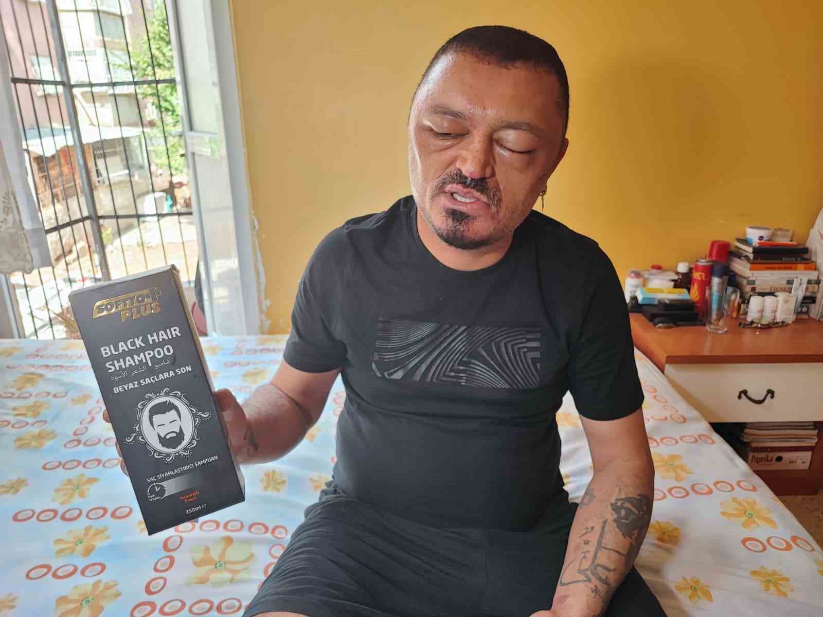 Sa&ccedil;larını siyahlatmak i&ccedil;in aldığı şampuan arı sokmasından beter hale getirdi
