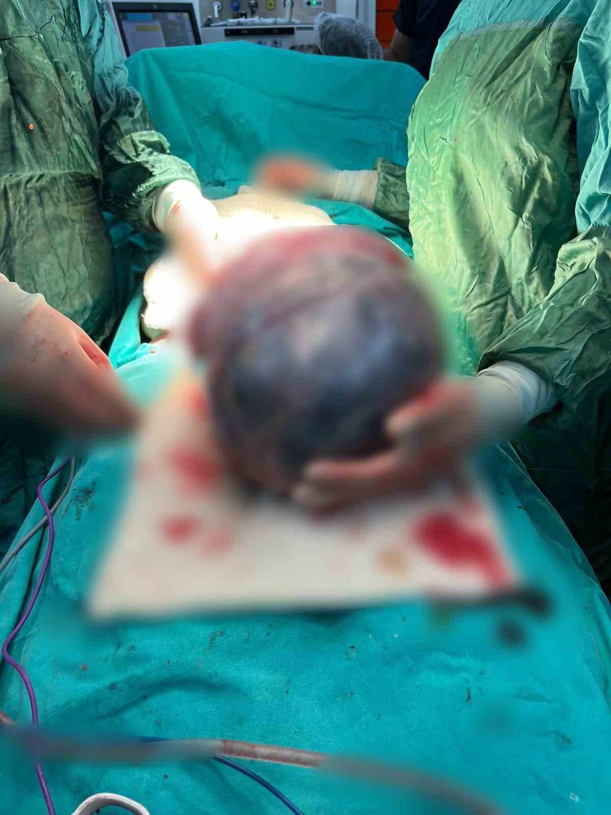 Operasyona alınan hastanın karnından ’dev tümör’ çıktı
