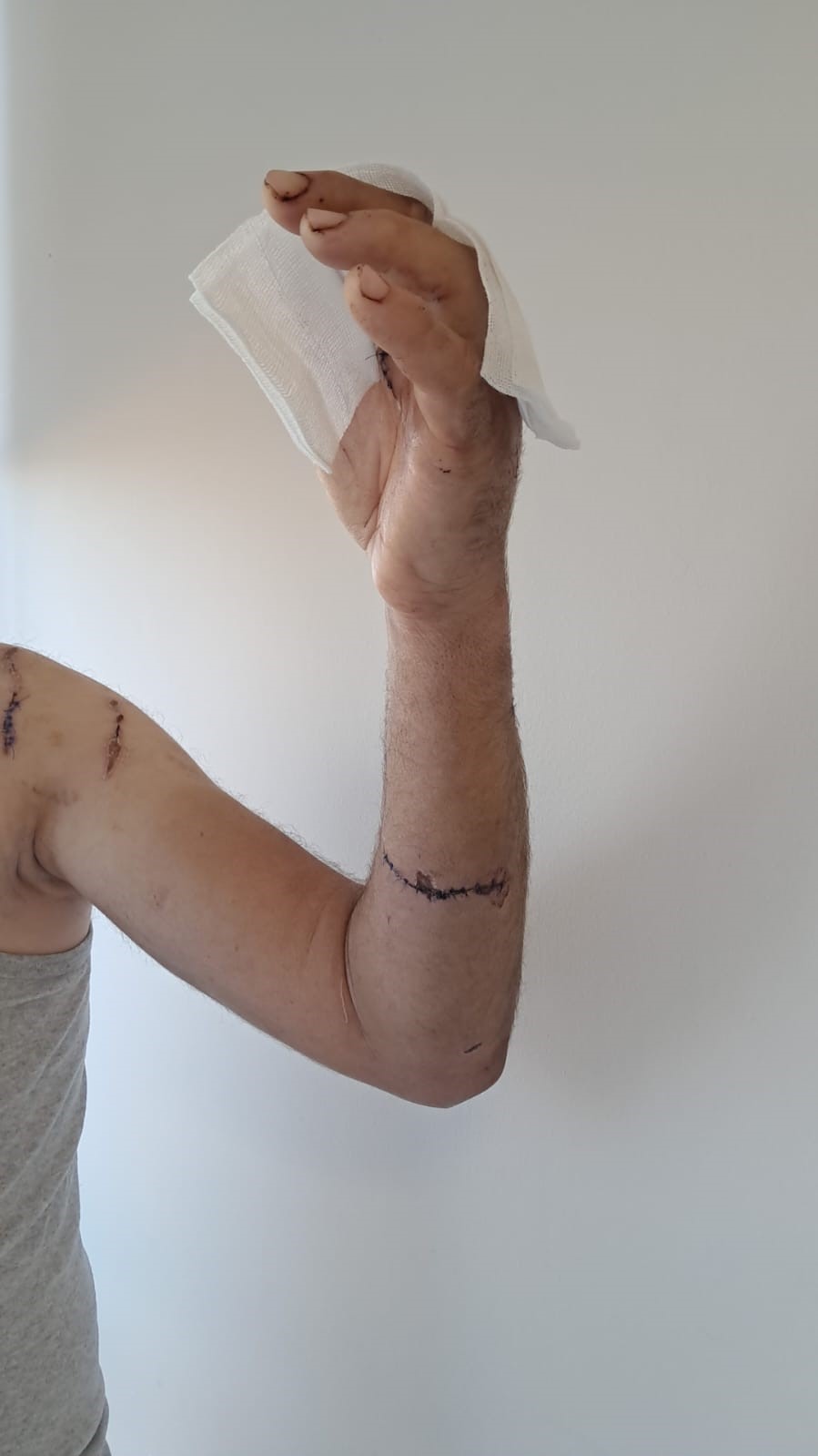 Ayının saldırısına uğrayan &ccedil;ift&ccedil;i dehşet anlarını anlattı: "Parmağımı kopardı"
