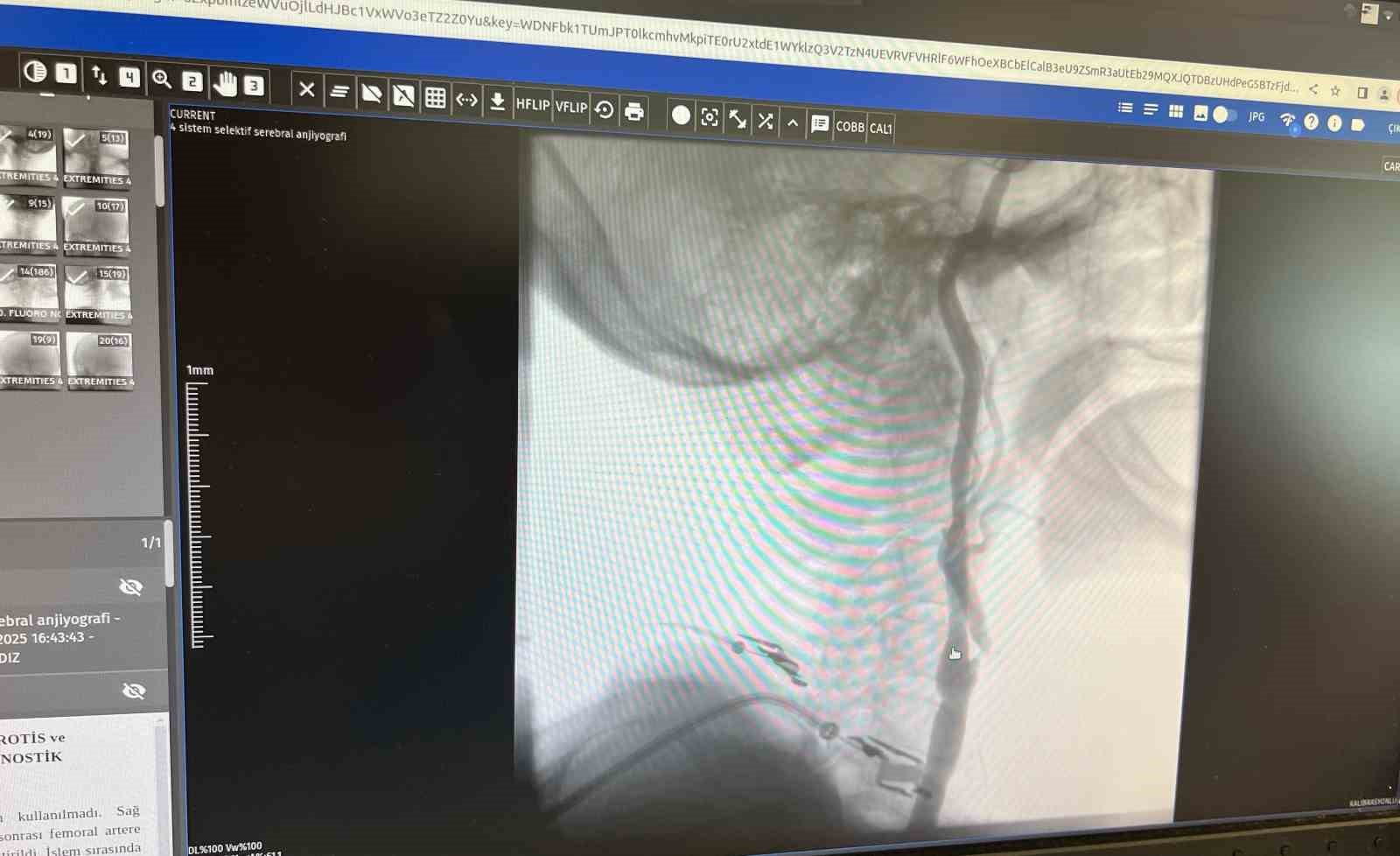 Manisa Şehir Hastanesi’nde felç riskine karşı ameliyatsız çözüm

