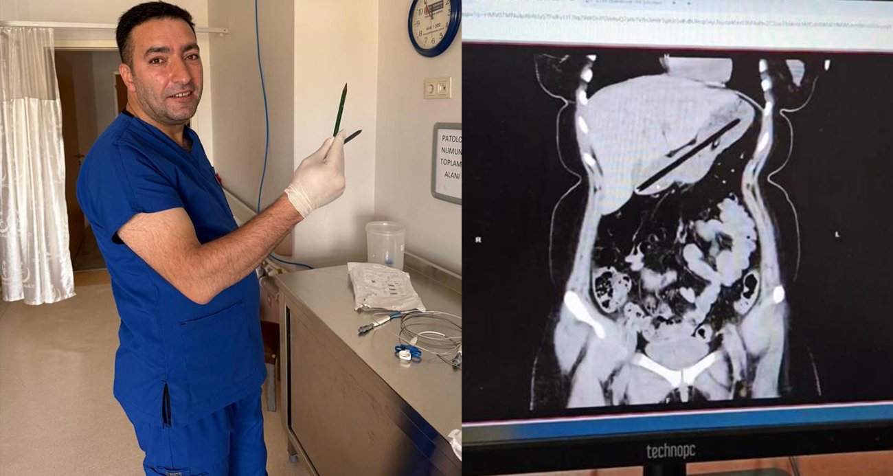 Ağrı’da genç kadının midesinden endoskopiyle iki kalem çıkarıldı