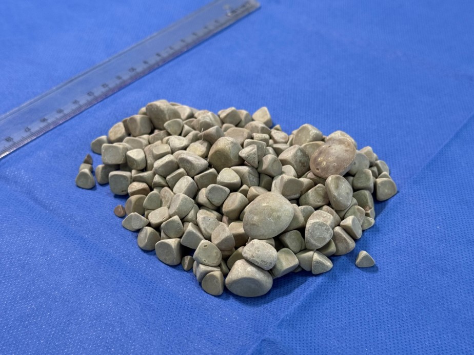 Vücudundan 287 tane taş çıkarıldı, doktorlar bile şok oldu: 