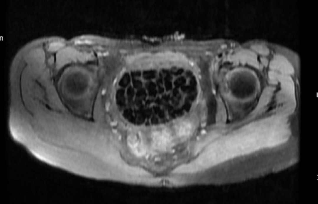 Vücudundan 287 tane taş çıkarıldı, doktorlar bile şok oldu: 