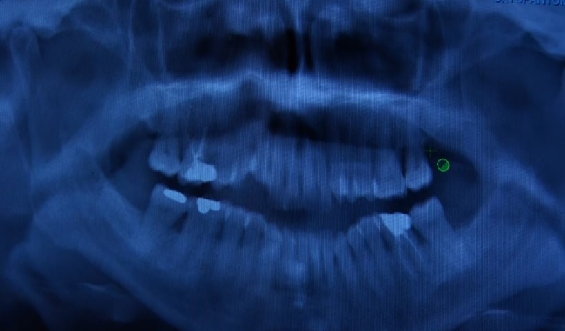 Diş eti problemlerine dikkat, uzmanlar uyarıyor: 