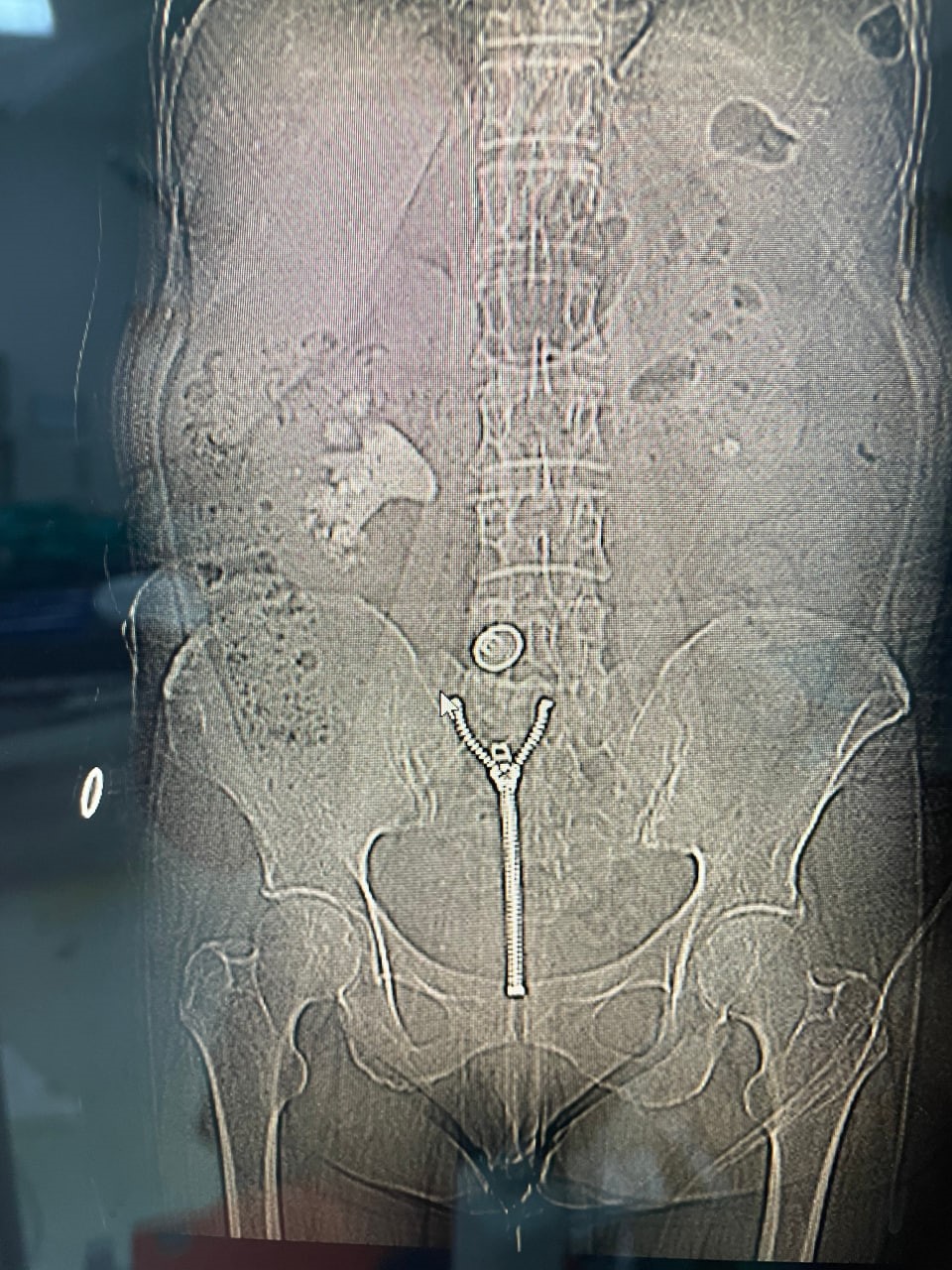 8 santimetrelik ’geyik boynuzu’ böbrek taşı kapalı yöntemle çıkarıldı