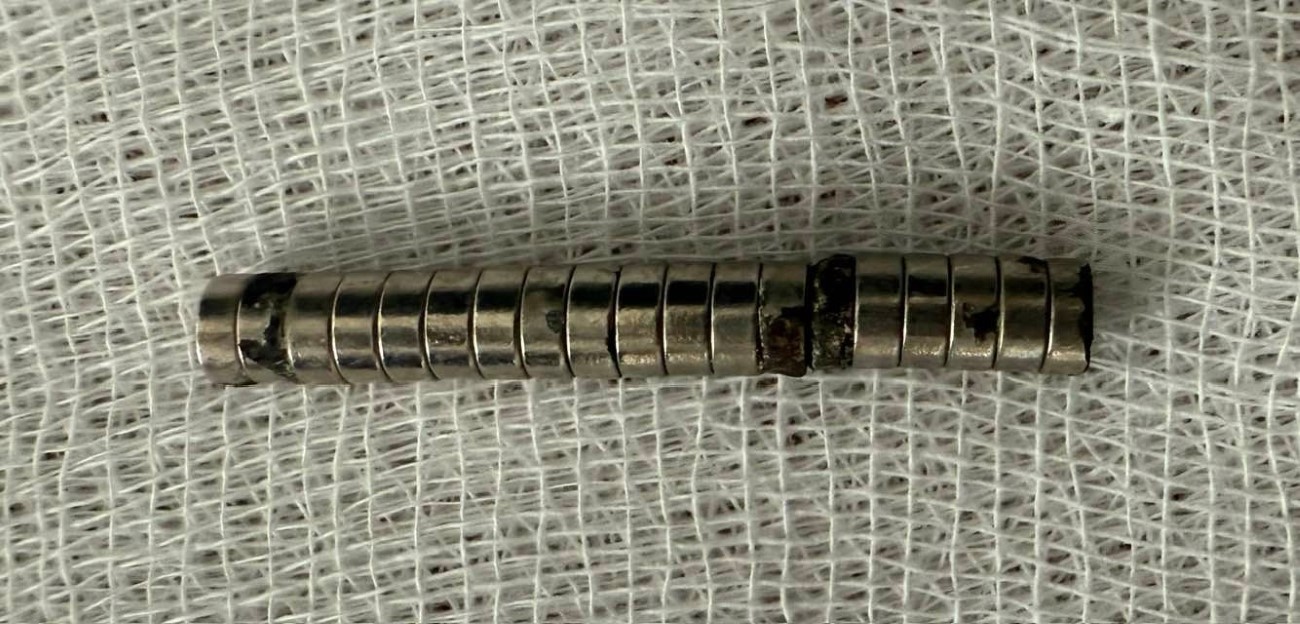 Çocuğun boğazından 19 adet mıknatıs çıkartıldı