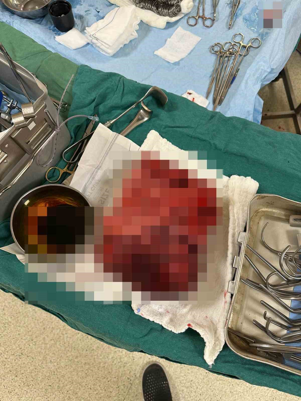 Nefes darlığı şikayeti ile hastaneye gitti, göğsünden 3 kilogramlık tümör çıktı
