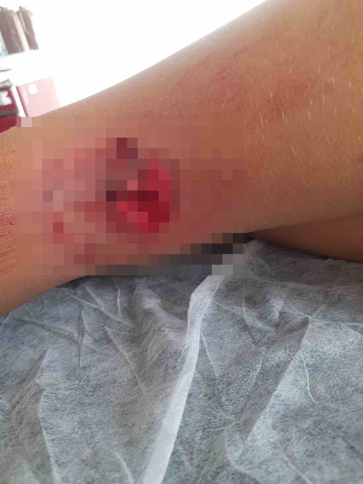 Okula giderken sokak köpeğinin saldırısına uğradı