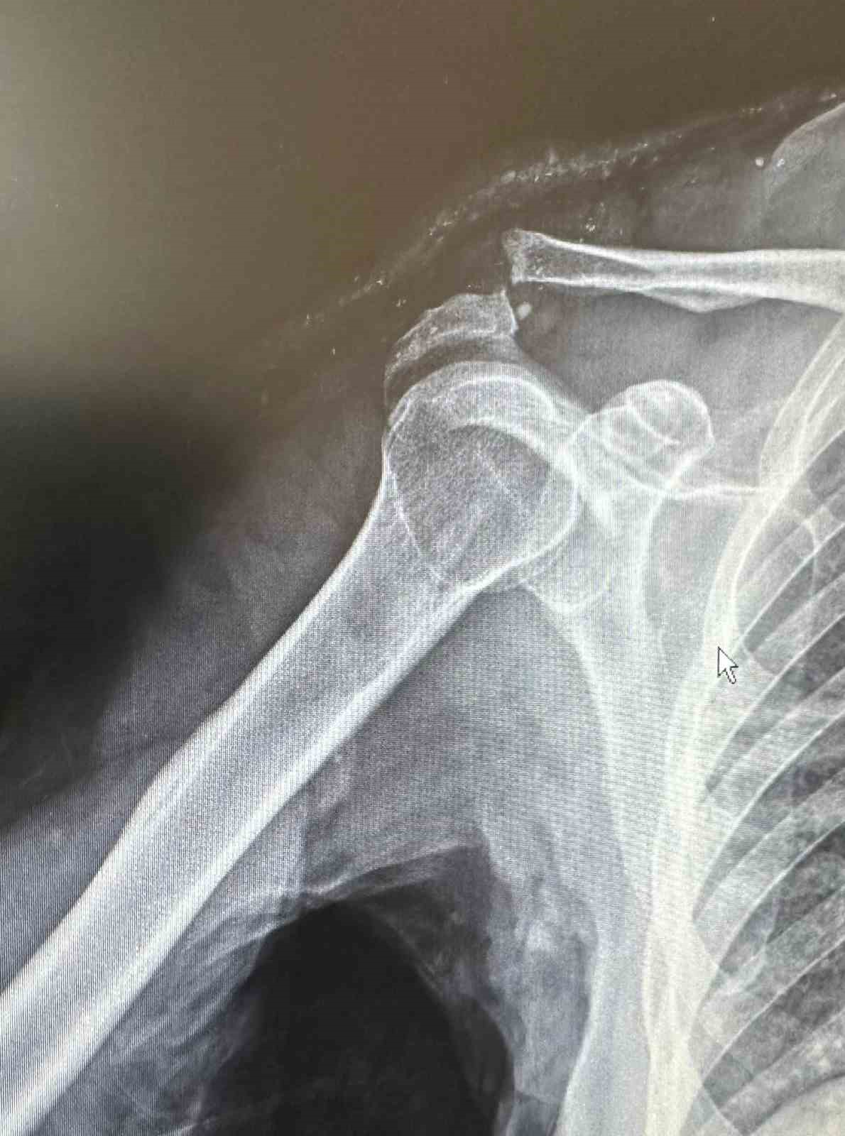 Tenis oynarken omuz çıkığı yaşayan 64 yaşındaki hasta, kullanılan özel plakla sağlığına kavuştu
