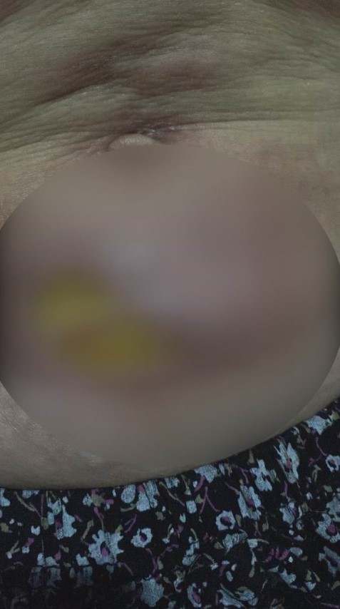 Yağ aldırma ameliyatı geçirdi hayatı karardı