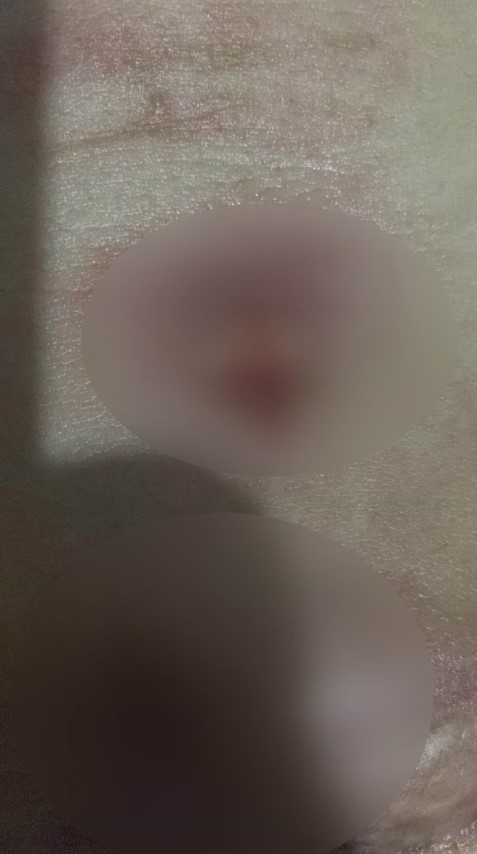 Yağ aldırma ameliyatı geçirdi hayatı karardı