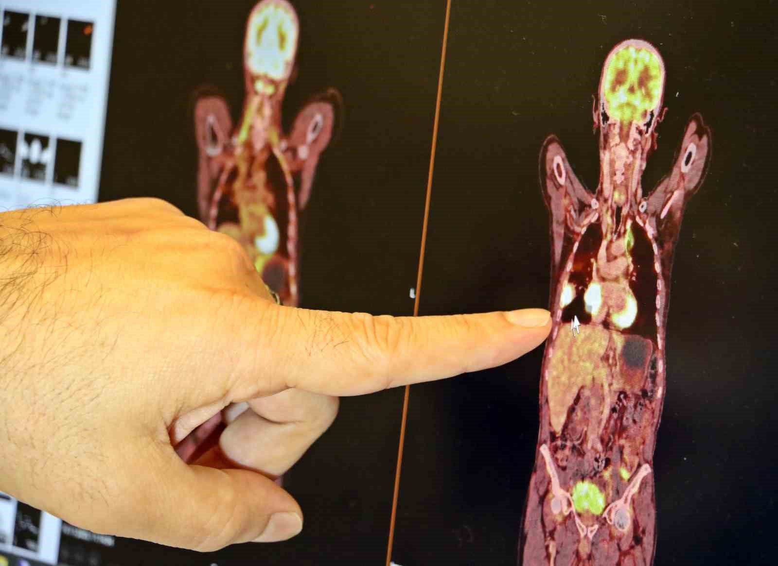 Prof. Dr. Ali Murat Tatlı: "Akciğer kanseri tedavisinde sağ kalım oranları artıyor"
