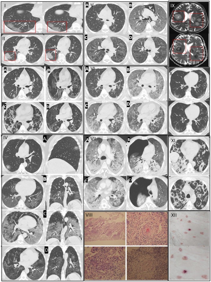 Gençlerde ani ölümler artıyor: "Nedeni ise virüsün damarlarda bıraktığı hasar"
