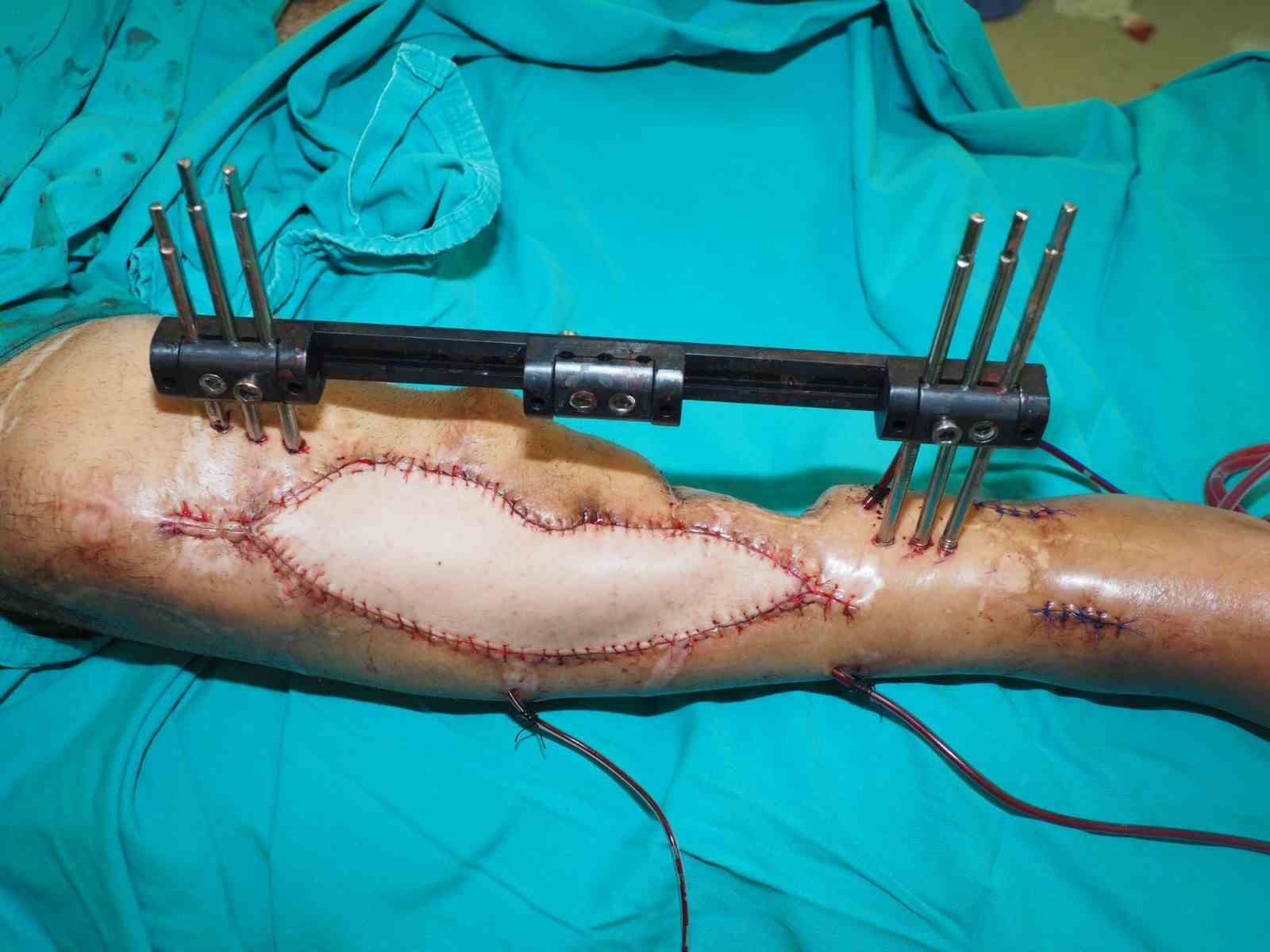 Kütahya’da mikrocerrahi operasyonla büyük başarı
