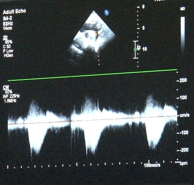 Çocuklarda kalp sağlığına dikkat: "Takipleri düzenli yaptıralım"
