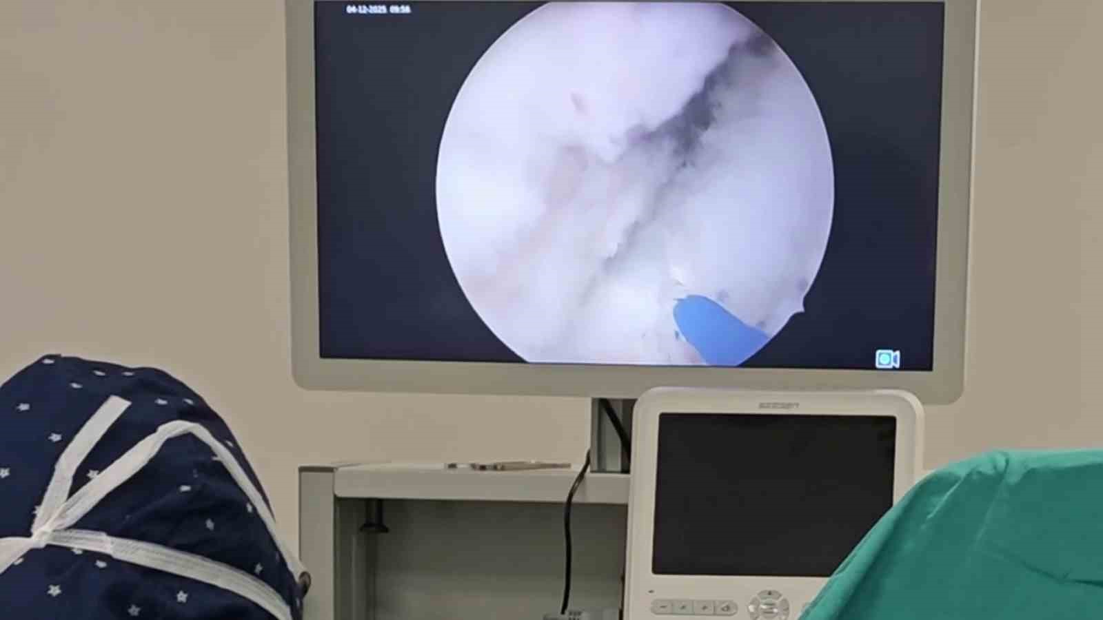 Prostata ’holep’ ile kesin çözüm: 400 grama kadar prostat güvenle alınabiliyor