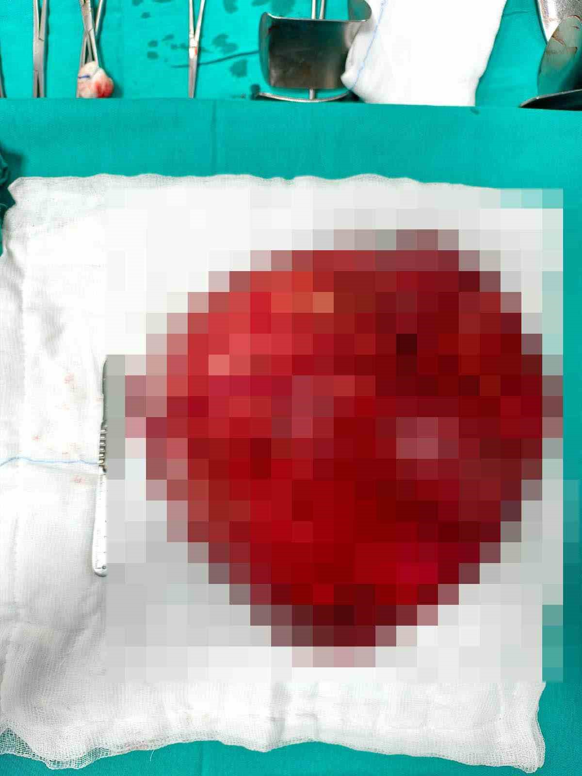 Karın boşluğundan 40 santimetre b&uuml;y&uuml;kl&uuml;ğ&uuml;nde kitle &ccedil;ıkarıldı
