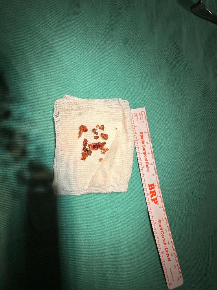 Elazığ&rsquo;da estetik ameliyatta şaşırtan olay, burundan taş &ccedil;ıktı