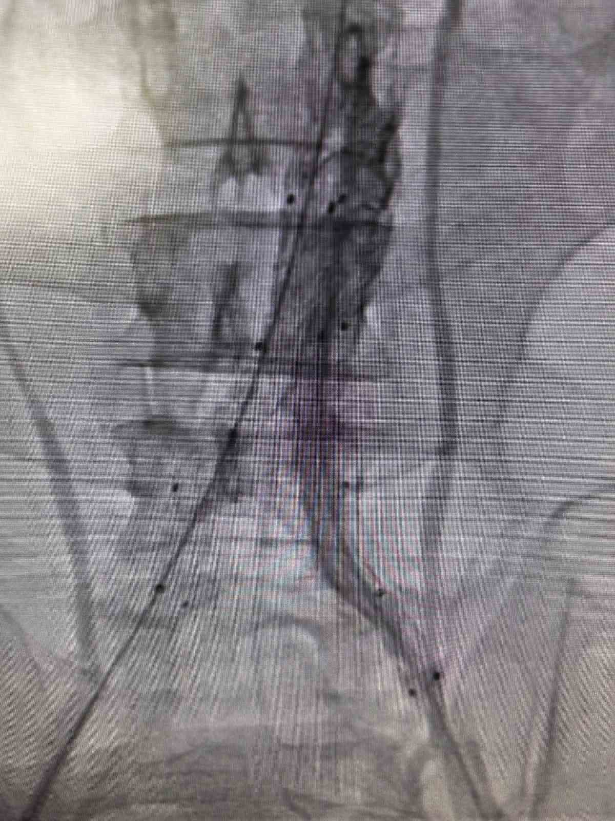 Bilecik&rsquo;te hayat kurtaran kapalı damar operasyonu

