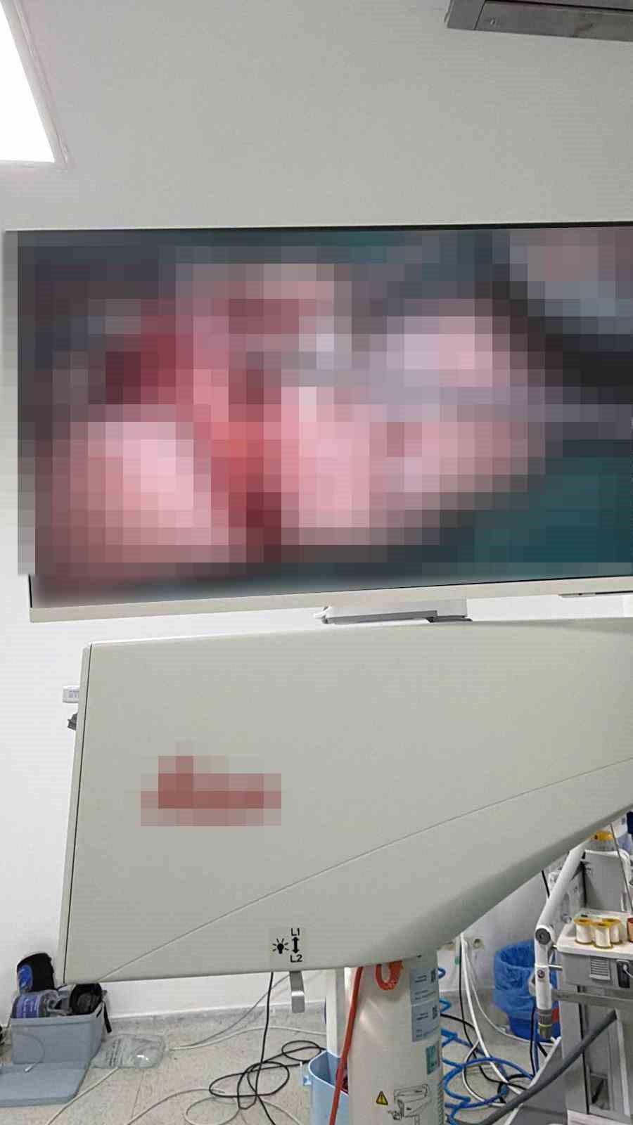 Bandırma’da asansör kazasında kopan parmak başarılı ameliyatla kurtarıldı