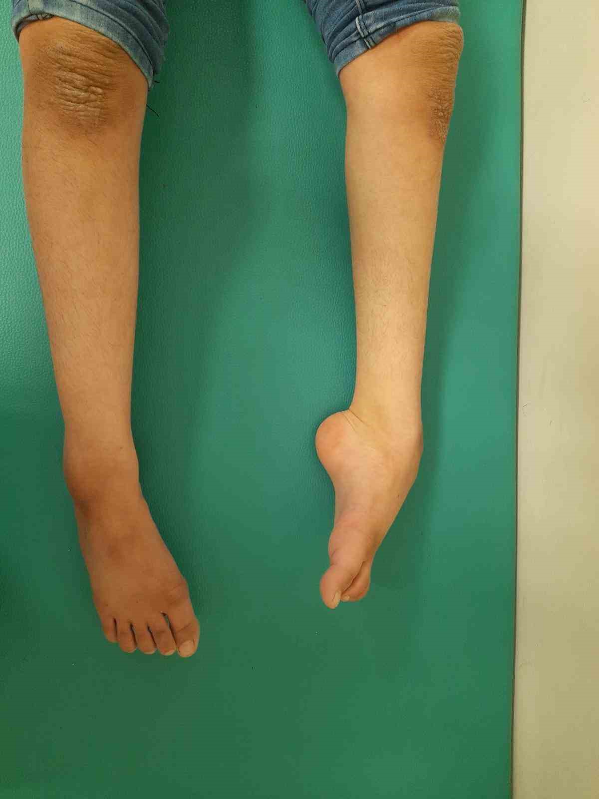 Şanlıurfa&rsquo;da yatağa bağlı kardeşler tedavi sonrası y&uuml;r&uuml;meye başladı
