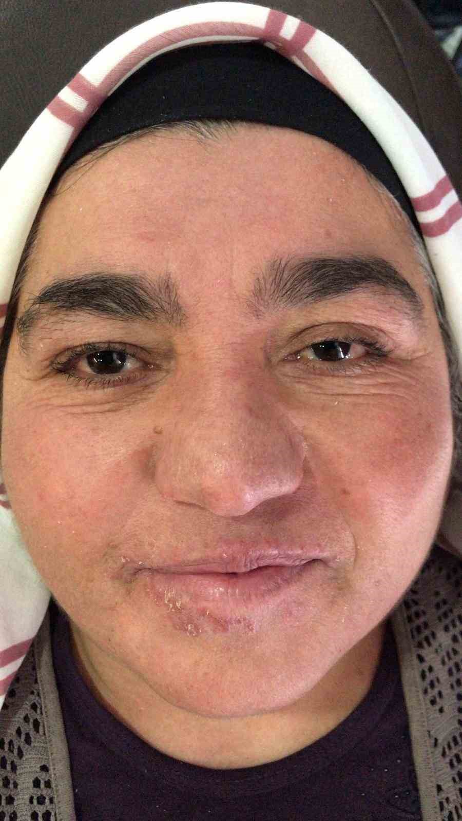 Hastalığı yüzünden yıllarca evden çıkamadı, şimdi ise çekinmeden çıkabiliyor