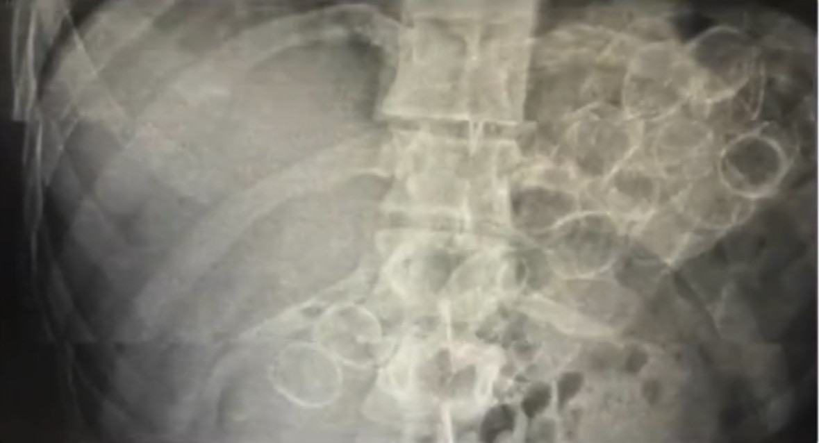 Mide ve bağırsaklarında uyuşturucu ele ge&ccedil;irilen 3 ş&uuml;pheli tutuklandı
