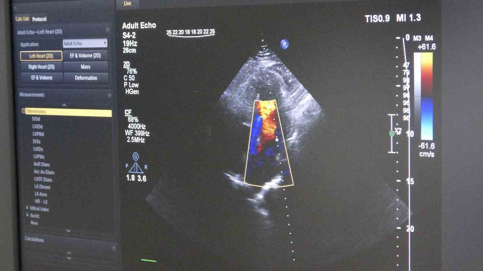 Ameliyatsız, stentsiz tedavi: Kalp damarları ilaç kaplı balonla açıldı