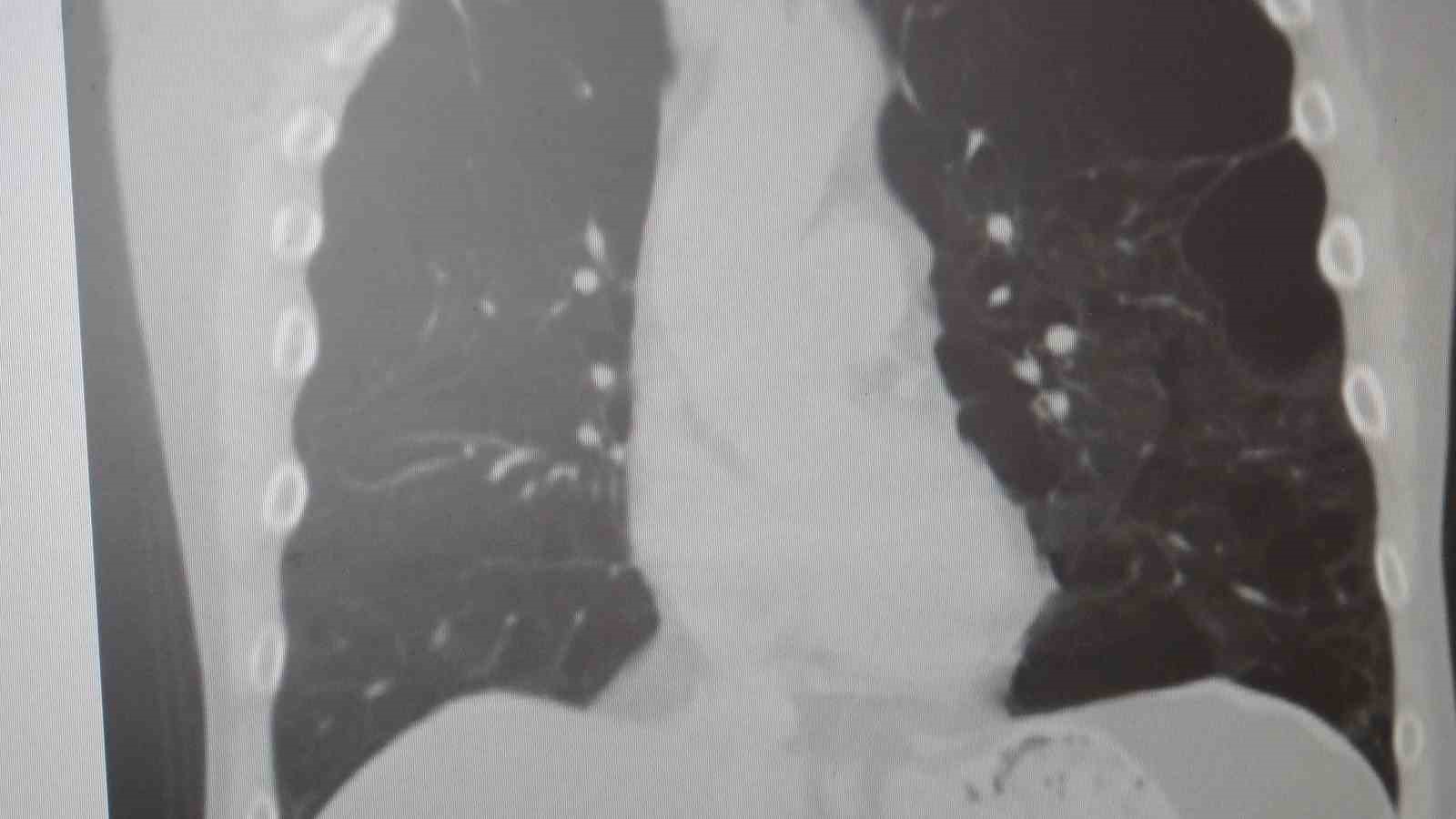 Uzmanından d&uuml;nyada en &ccedil;ok &ouml;ld&uuml;ren 4&rsquo;&uuml;nc&uuml; hastalık i&ccedil;in uyarı: "KOAH&rsquo;ı sigarayı bırakmak, zat&uuml;rreyi aşı durdurur"
