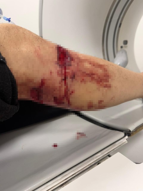 Nizip&rsquo;te başıboş k&ouml;pek saldırısında yaralanan 2 kişi belediyeye tepki g&ouml;sterdi