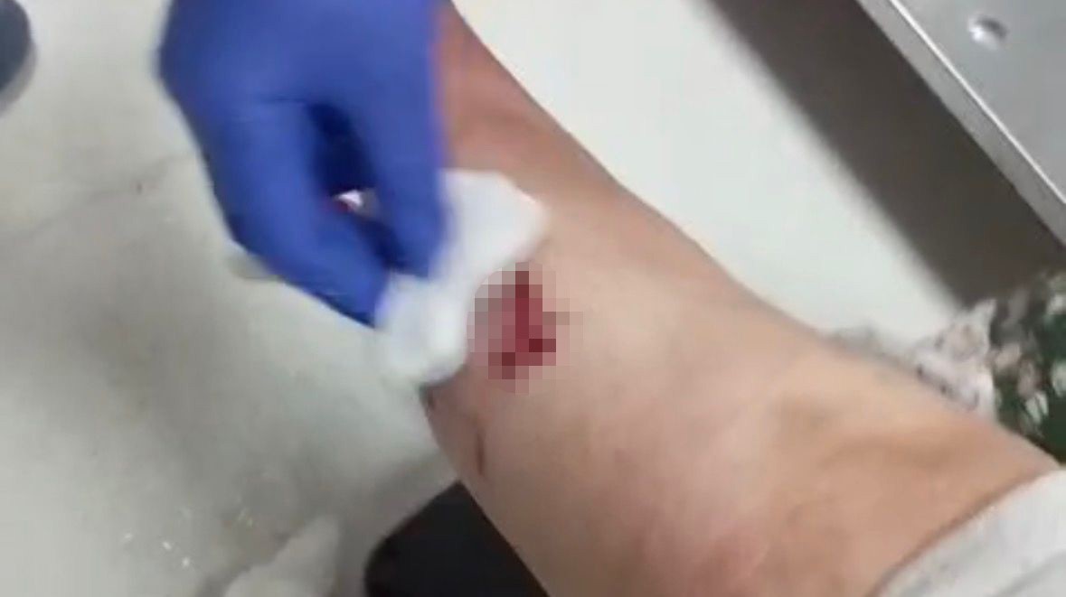 Nizip&rsquo;te başıboş k&ouml;pek saldırısında yaralanan 2 kişi belediyeye tepki g&ouml;sterdi