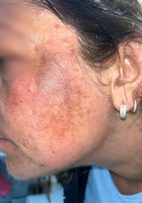 G&uuml;zelleşmek uğruna gittiği merkezde y&uuml;z&uuml; yandı