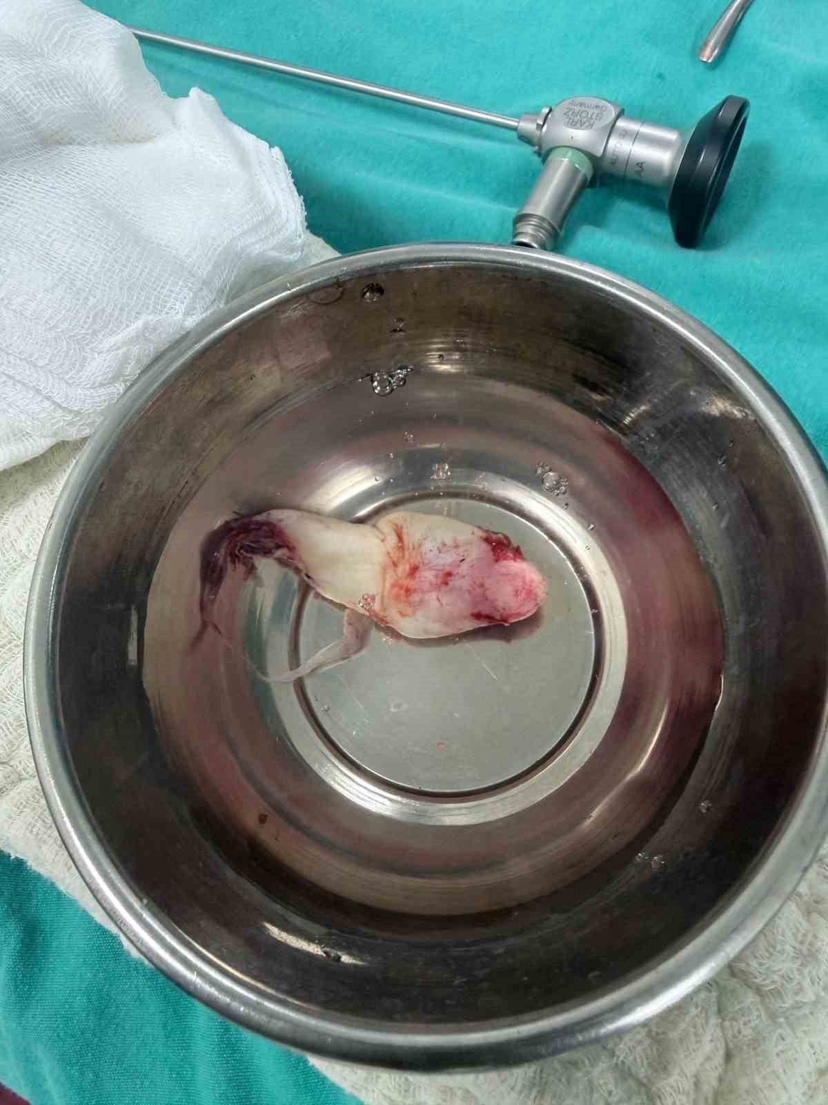 Burun tıkanıklığı ve işitme kaybı şikayetiyle gitti, ameliyatta dev bir polip &ccedil;ıkartıldı
