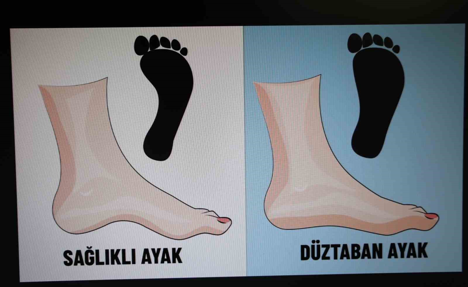 Ortopedi Uzmanı Dr. Ayhan:" &Ccedil;ocuklarda d&uuml;ztabanlık y&uuml;zde 90 oranında ge&ccedil;icidir"